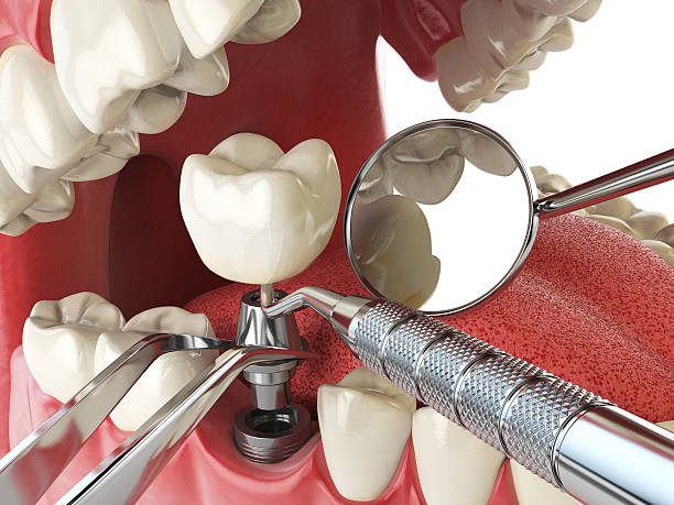 Best Emergency Dentist for Lost Fillings or Crowns in Litchfield, MI